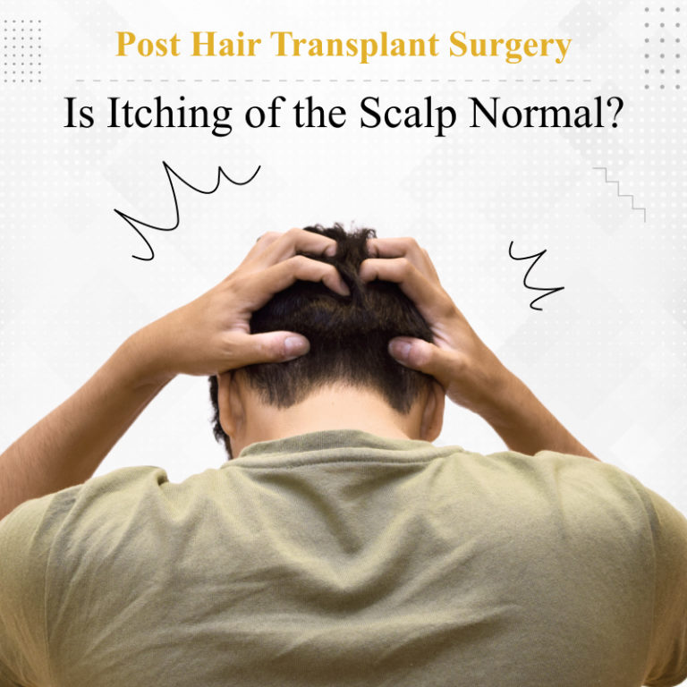 Is It Okay for Your Scalp to Itch Post Hair Transplant Surgery?