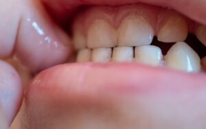 Bruxism In Child How To Stop Grinding Teeth