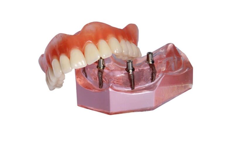 Unveiling The Potential Of Implant-Supported Dentures