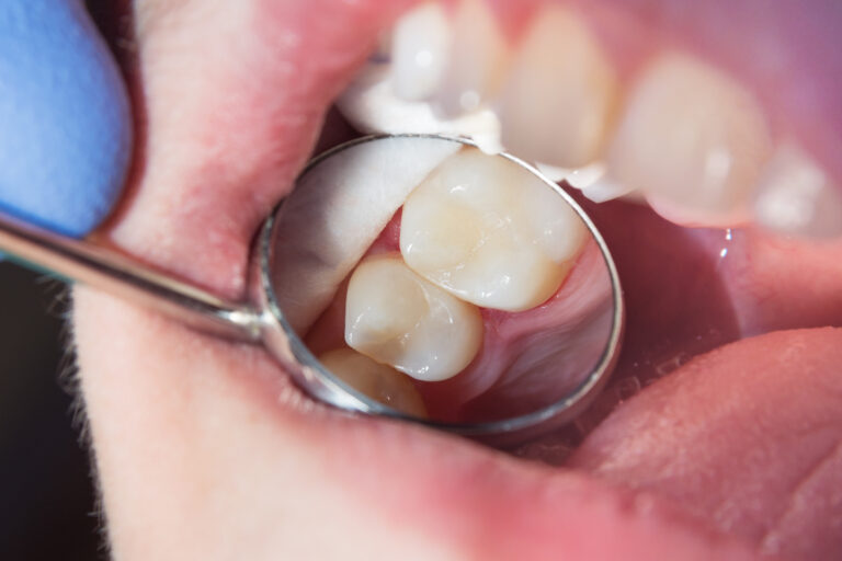 Discover the Benefits of Dental Crowns for Enhancing Tooth Longevity