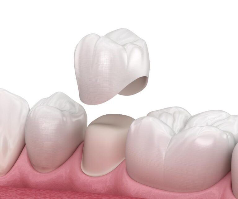 A Lasting Investment: The Long-Term Benefits of Porcelain Crowns